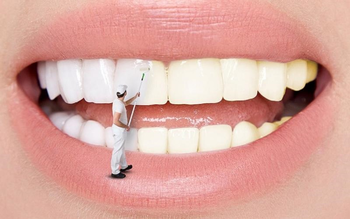 Răng sâu có tẩy trắng được không? Tẩy trắng có làm hỏng men răng không?
