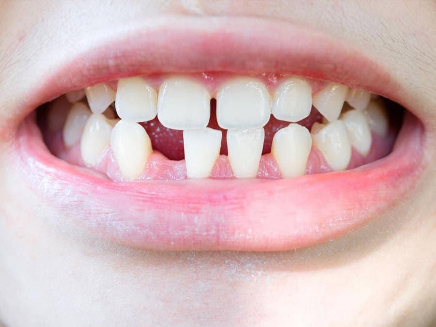 Mọc thiếu răng có sao không? Cách khắc phục hàm thiếu răng là gì?