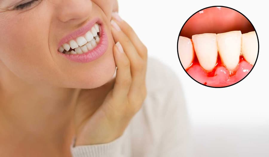 10+ Nguyên nhân chảy máu chân răng và cách điều trị hiệu quả