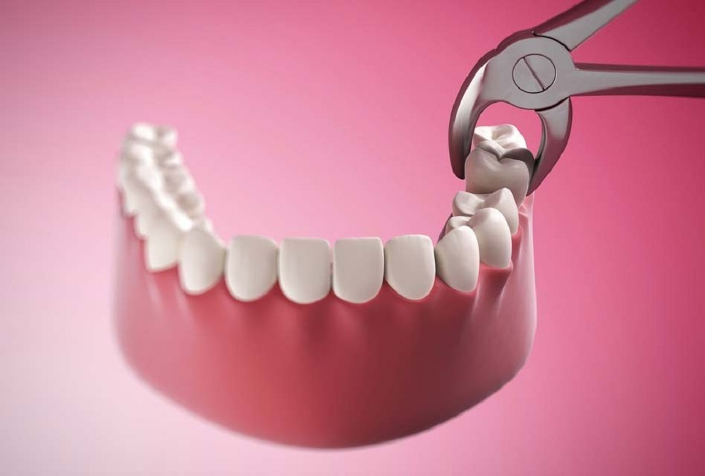 Những biến chứng khi nhổ răng khôn và cách phòng tránh