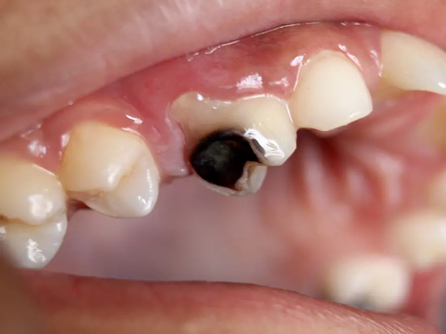 Điều trị sớm có thể giúp ngăn ngừa các biến chứng nghiêm trọng, chẳng hạn như áp xe răng hoặc mất răng.