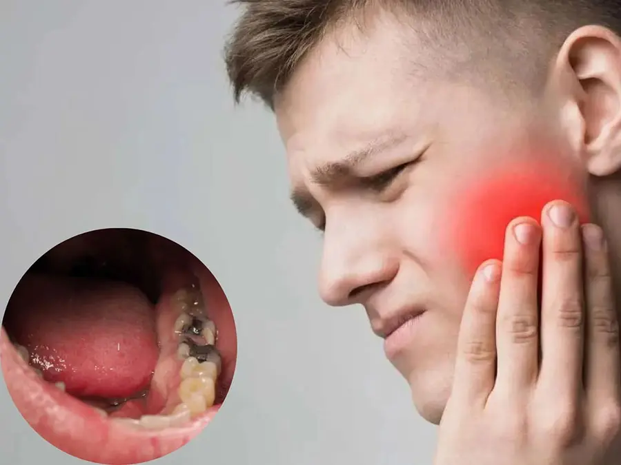 Sâu răng vào tủy rất đau nhức vì tủy răng là một tổ chức nhạy cảm chứa các dây thần kinh và mạch máu.
