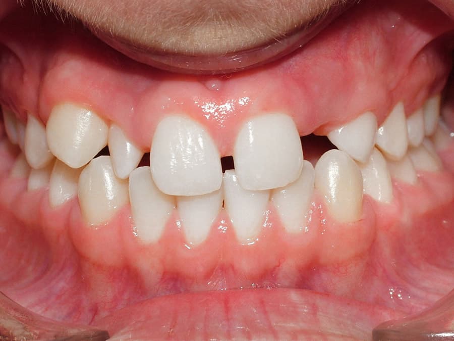 Mọc thiếu răng có sao không? Cách khắc phục hàm thiếu răng là gì?
