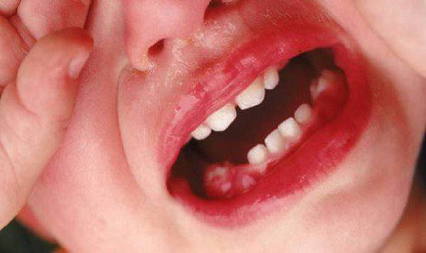 Sốt nhẹ là dấu hiệu khi trẻ mọc răng