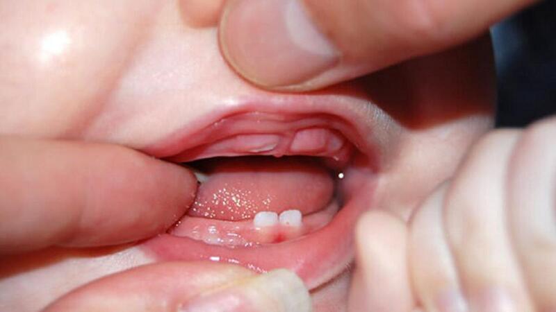 Bé thường mọc răng đầu vào 6 tháng tuổi