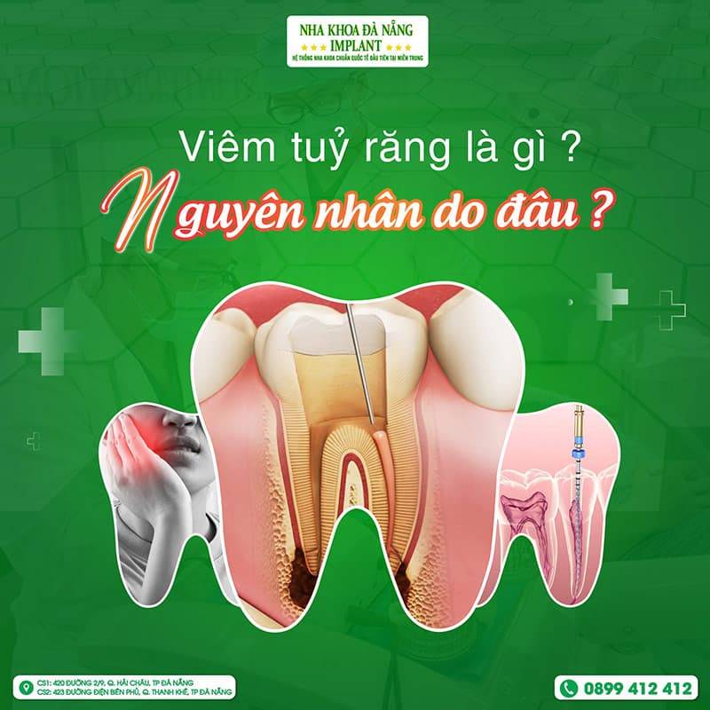 Nguyên nhân viêm tủy răng, triệu chứng và cách điều trị