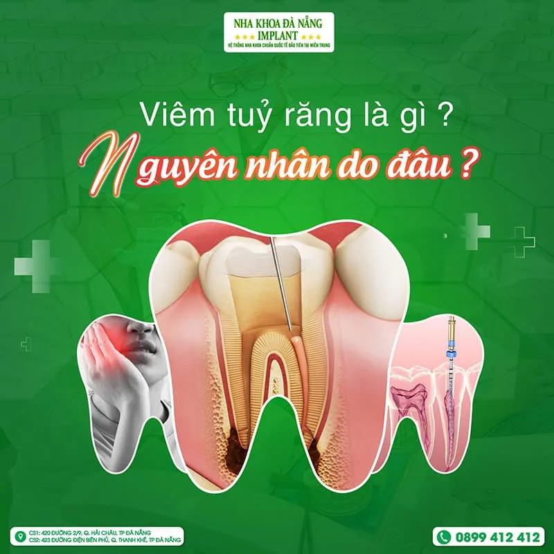 Nguyên nhân viêm tủy răng, triệu chứng và cách điều trị