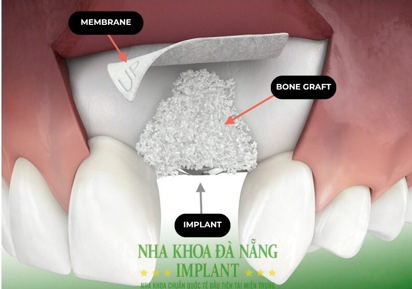 What is Dental Implant? Update the latest price list
