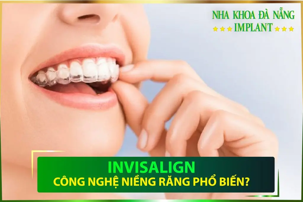 If you are interested in braces service in Da Nang, below is our service process