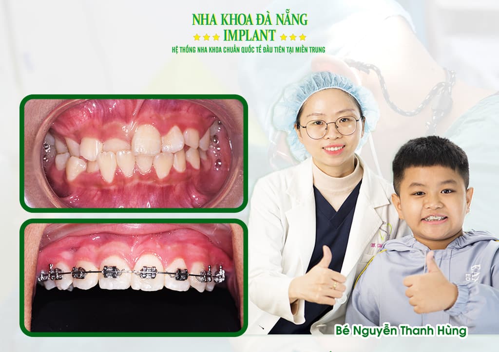 There are many places providing braces services in Da Nang, so what is different about Da Nang Implant Dentistry