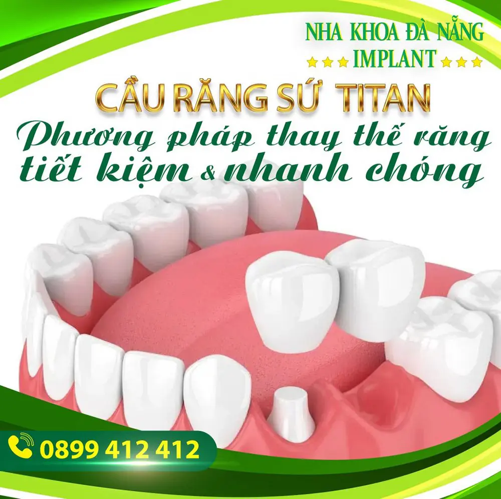 Porcelain dental bridge – A quick & economical replacement method