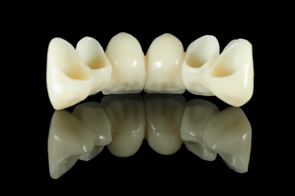 Installing a porcelain dental bridge is a solution to help restore one or more lost teeth