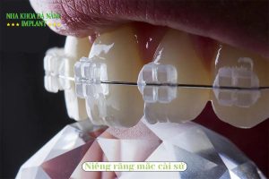 What are ceramic braces? What are the pros and cons?