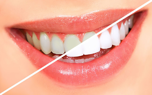 Choosing the color of porcelain teeth that matches your skin color is very necessary