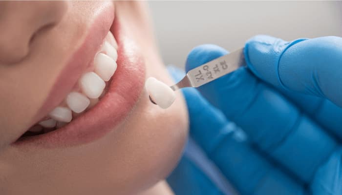 Tips for choosing the suitable teeth color when making ceramic teeth