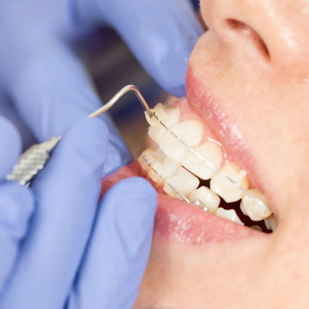 The success of a ceramic braces treatment depends greatly on the expertise of the doctor.