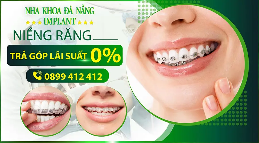 Metal braces with 0% interest installment payment at Da Nang Implant Dental Clinic