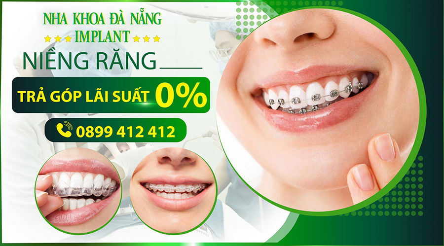 Protruding teeth braces with 0% interest installments at Da Nang Implant Dental Clinic