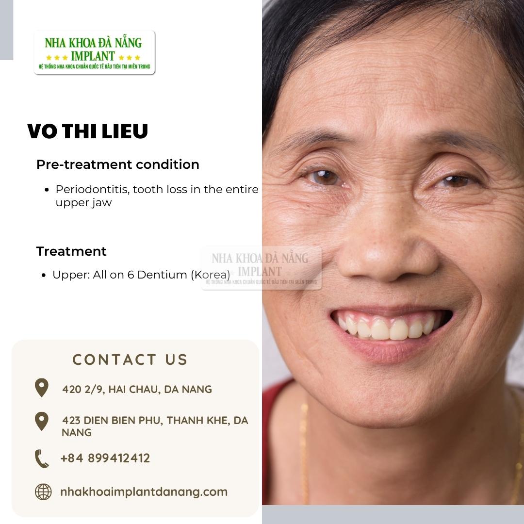 Customer Vo Thi Lieu - Treatment: All on 6 Dentium (Korea)