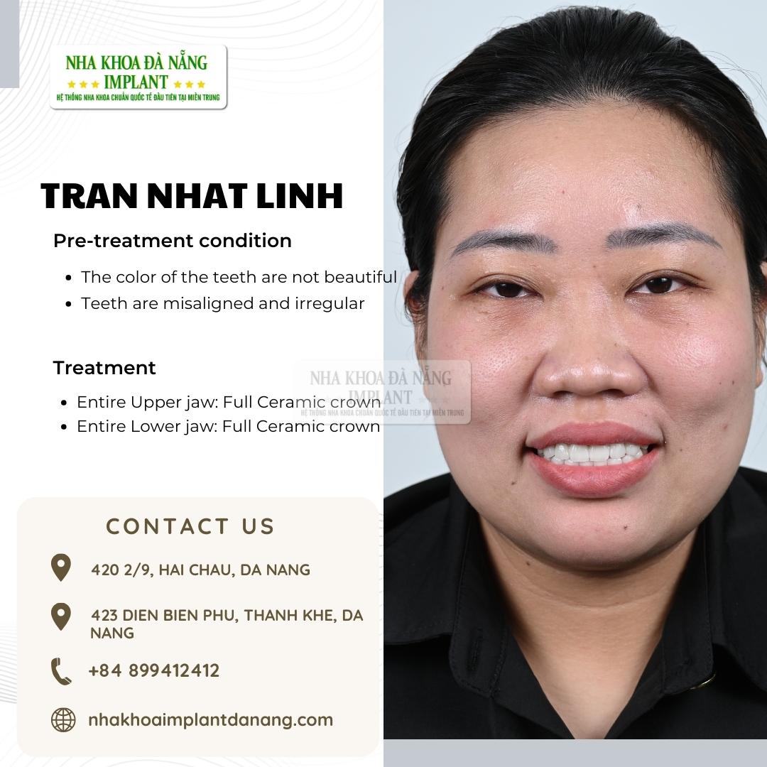 Customer: Tran Nhat Linh - Treatment: All-ceramic crowns