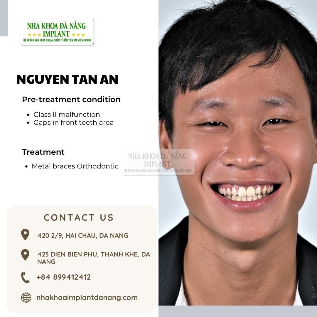 Customer: Nguyen Tan An - Treatment: Dental Braces
