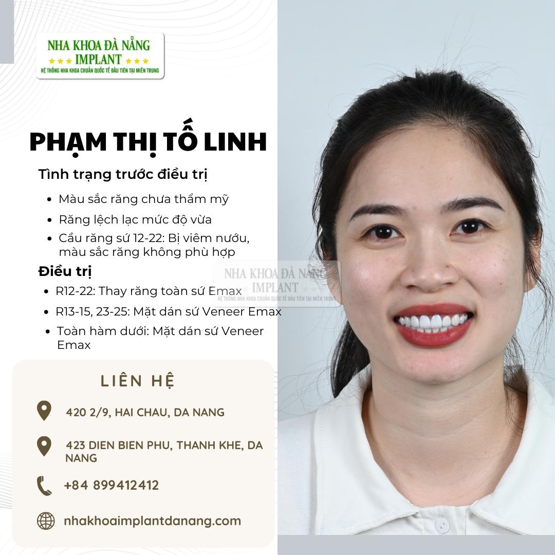 Khách hàng Phạm Thị Tố Linh - Điều trị: Mặt dán sứ Veneer