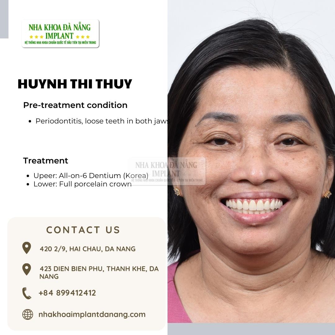 Customer Huynh Thi Thuy - Treatment: All on 6 Dentium (Korea), All-ceramic teeth