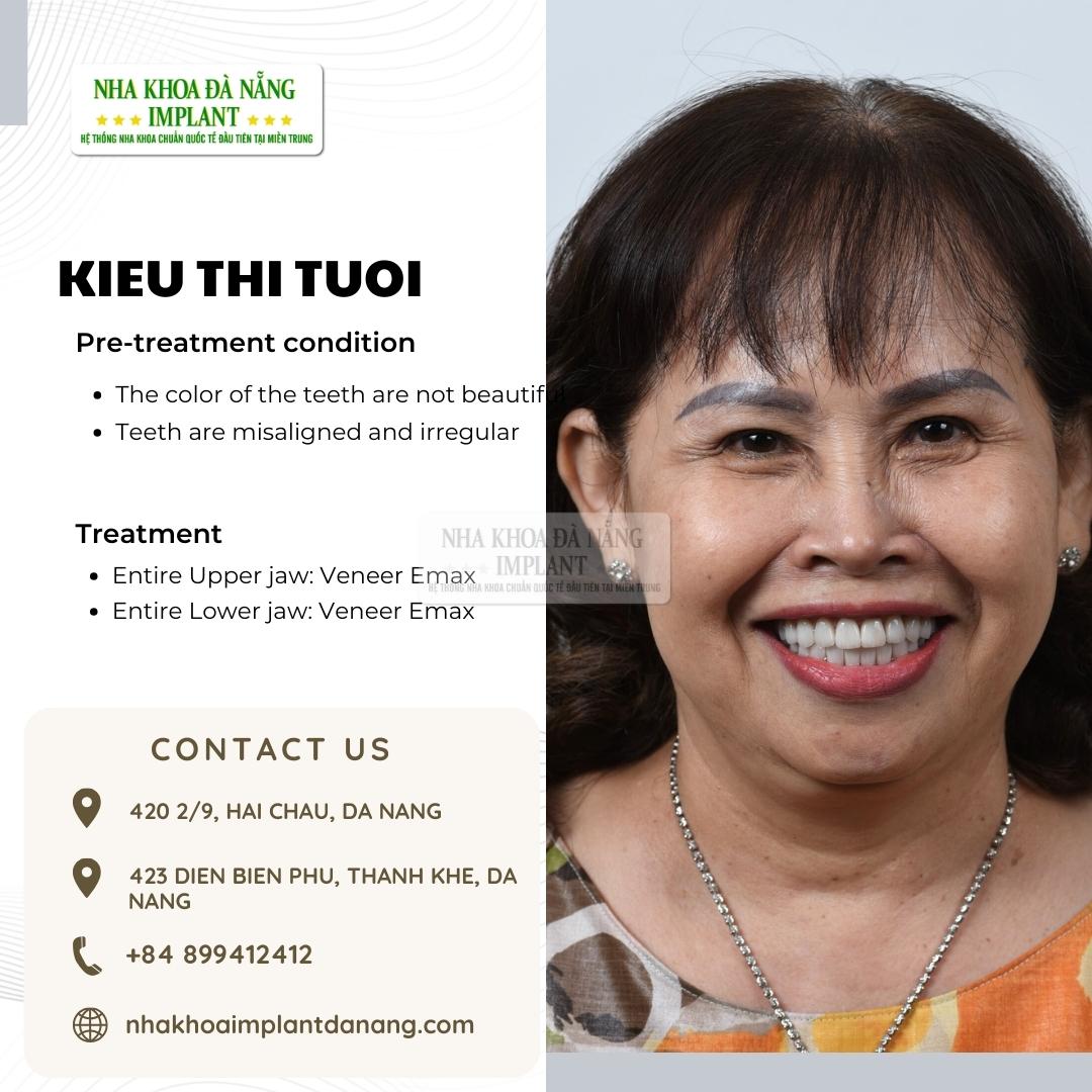 Customer: Kieu Thi Tuoi - Treatment: Porcelain Veneers