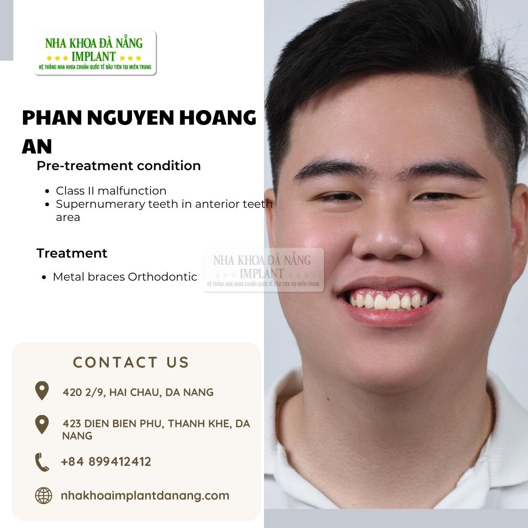 Customer: Phan Nguyen Hoang An - Treatment: Dental Braces