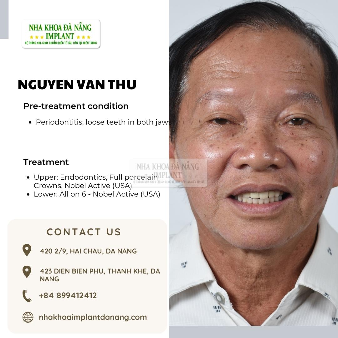 Customer Nguyen Van Thu - Treatment: All on 6, All on 4 Nobel Active (USA)