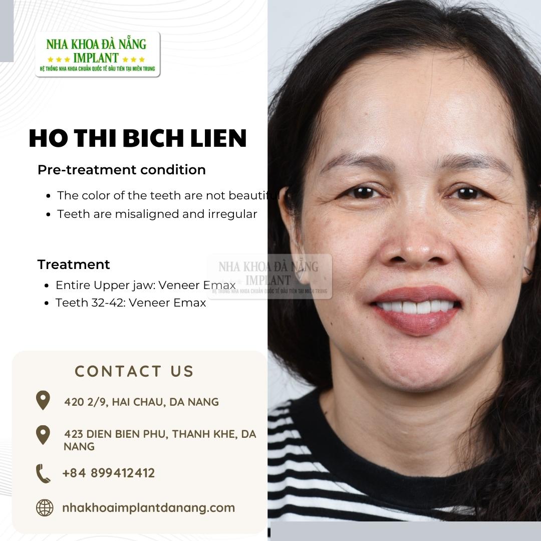 Customer: Ho Thi Bich Lien - Treatment: Porcelain Veneers