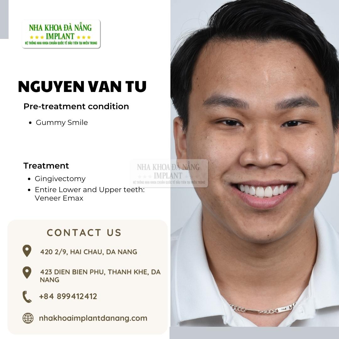 Customer Nguyen Van Tu - Treatment: Gingivectomy, Porcelain Veneer