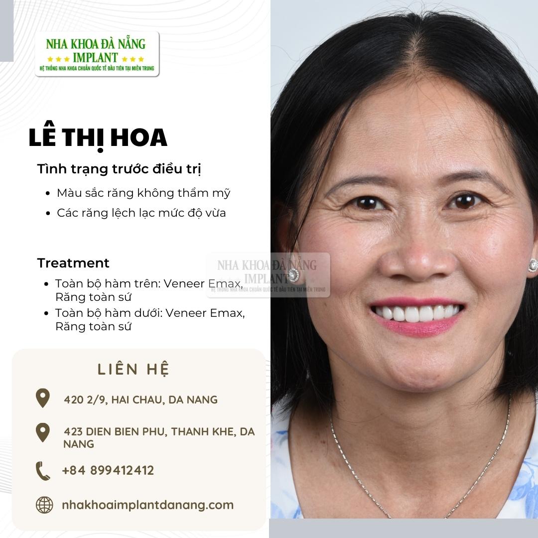 Khách hàng Lê Thị Hoa - Điều trị: Mặt dán sứ Veneer, Răng toàn sứ