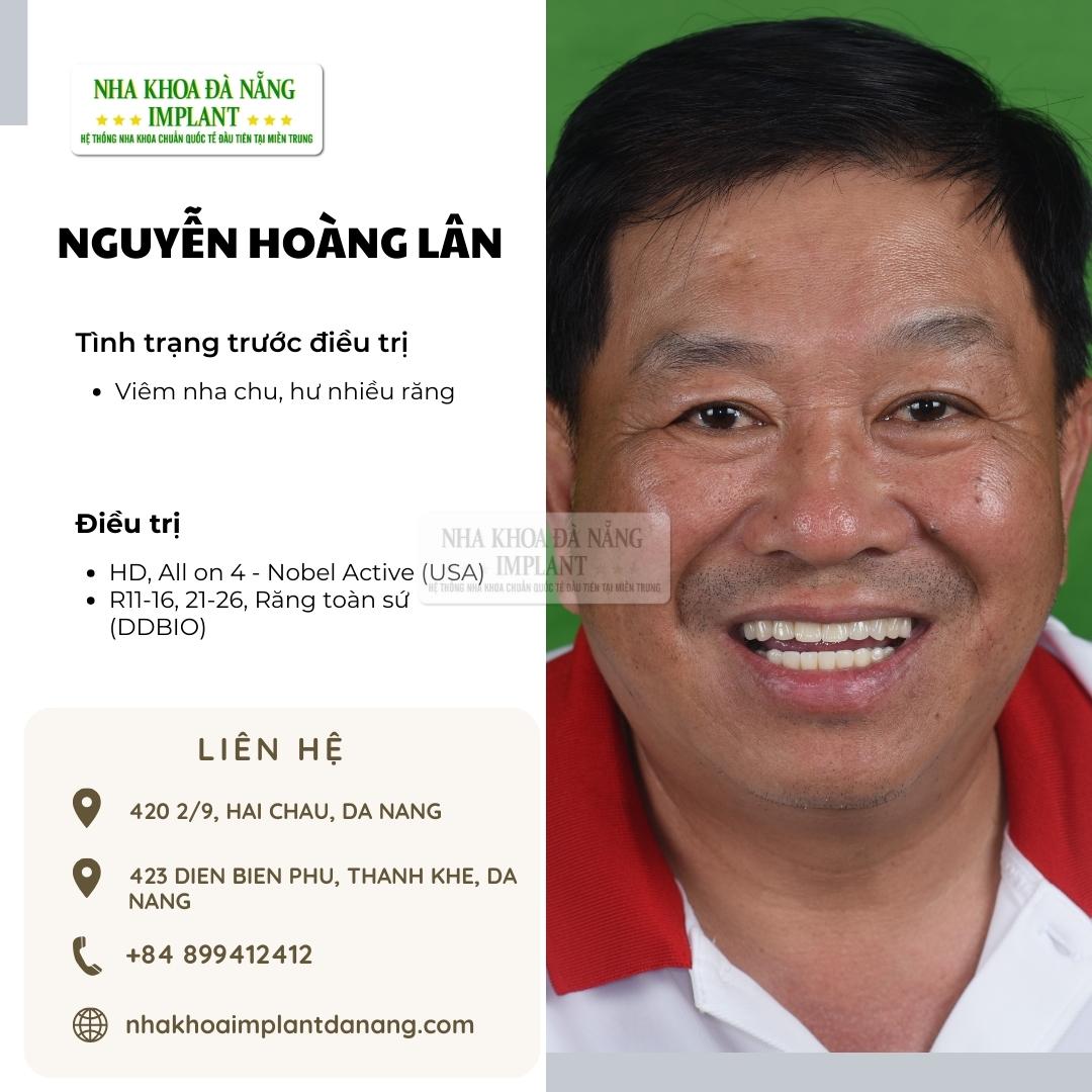 Khách hàng: Nguyễn Hoàng Lân - Điều trị: All on 4 Nobel Active (USA), Răng toàn sứ