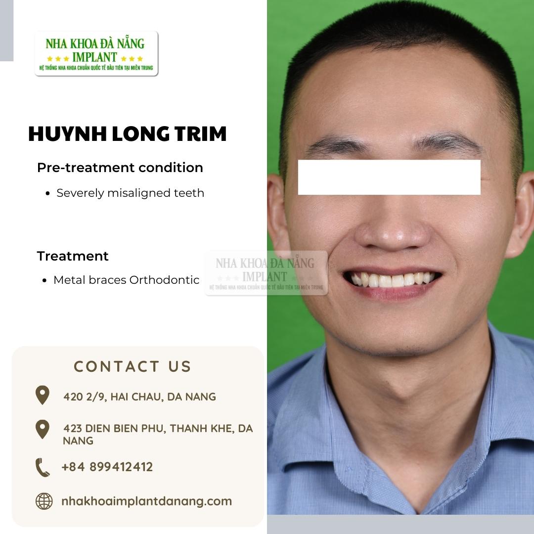 Customer: Huynh Long Trim - Treatment: Dental Braces