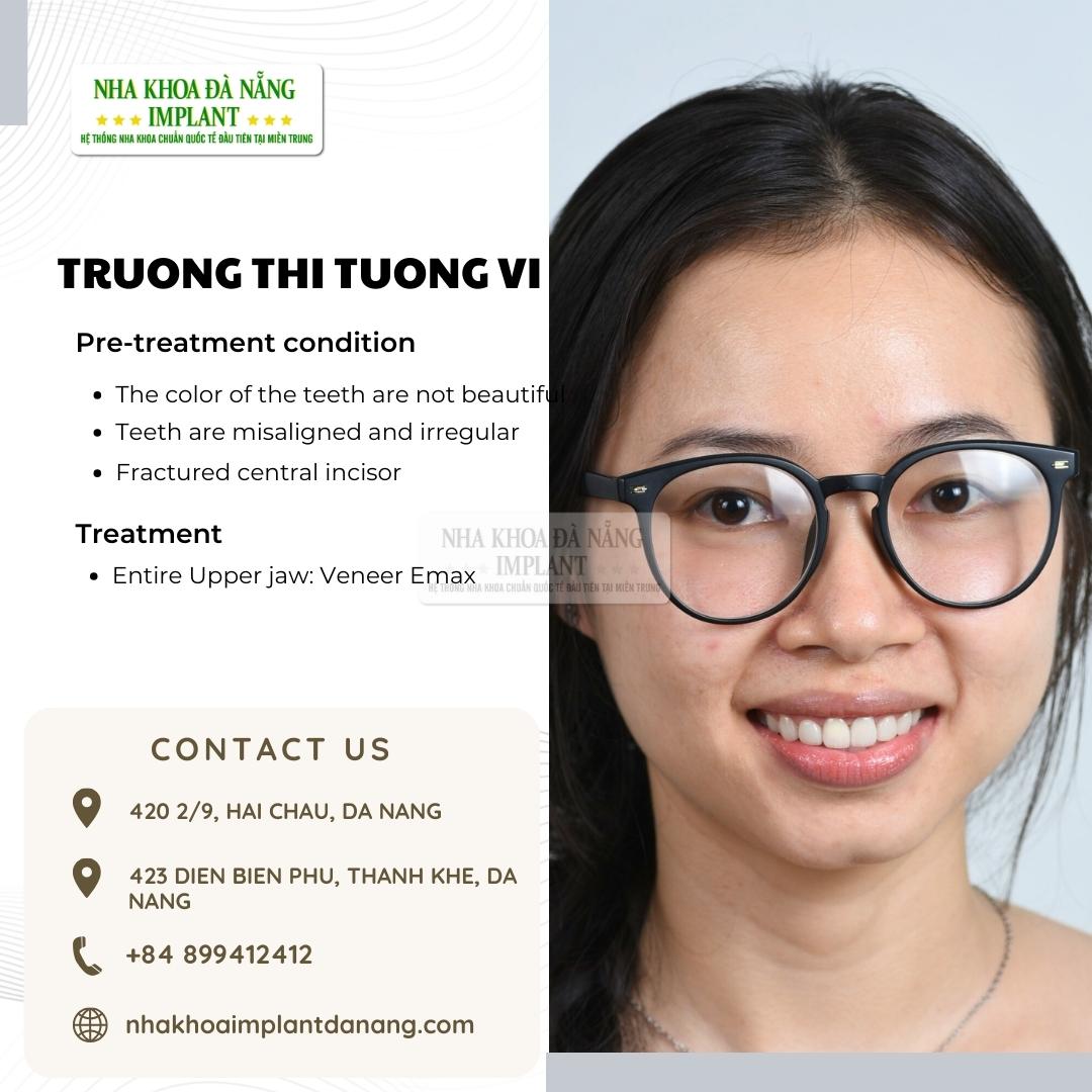 Customer: Truong Thi Tuong Vi - Treatment: Porcelain Veneers