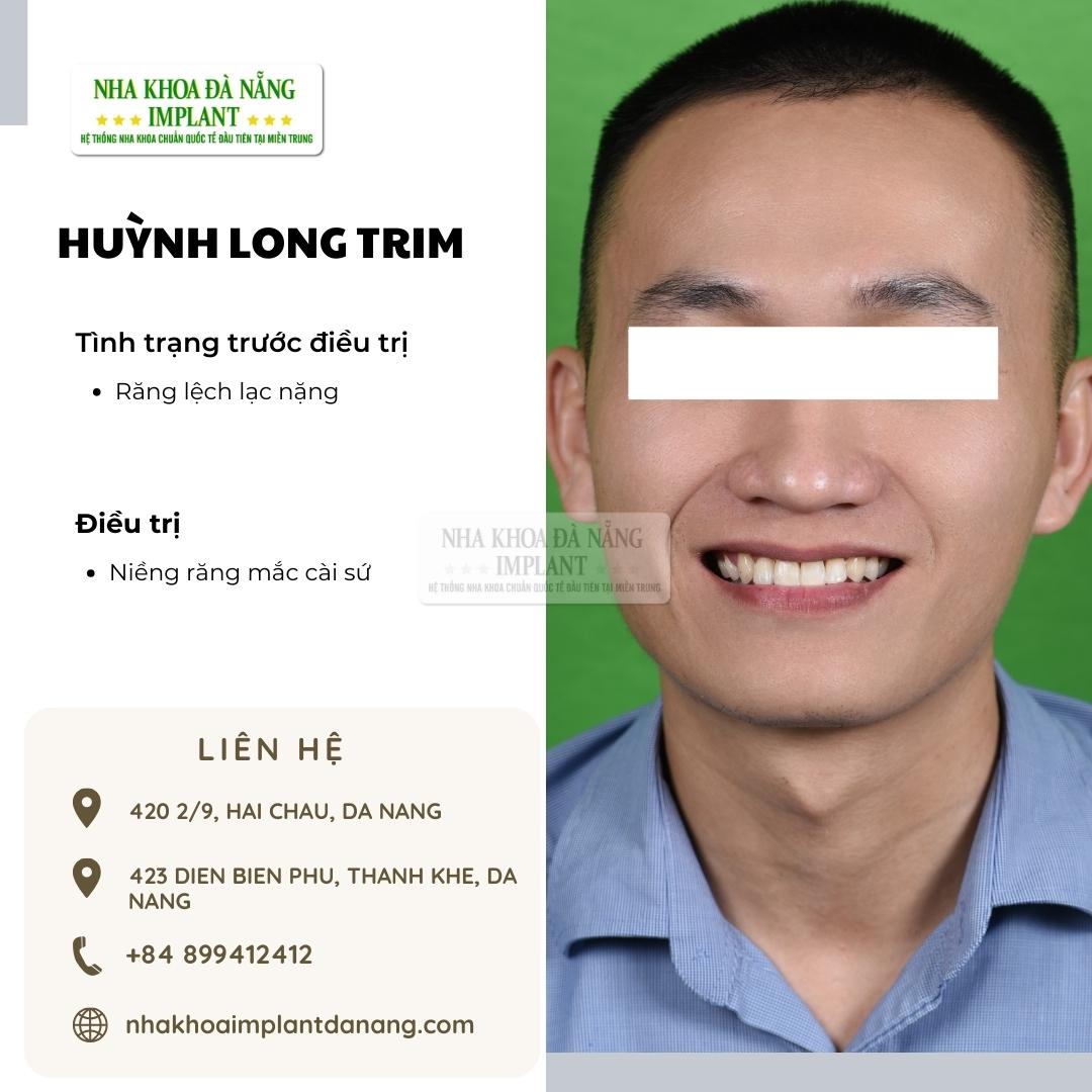 Khách hàng: Huỳnh Long Trim - Điều trị: Niềng răng mắc cài