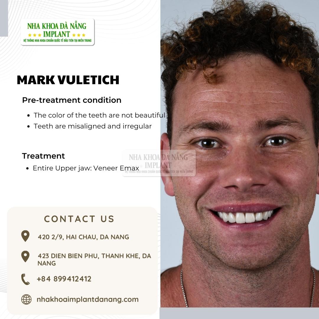 Customer: Mark Vuletich - Treatment: Porcelain Veneers