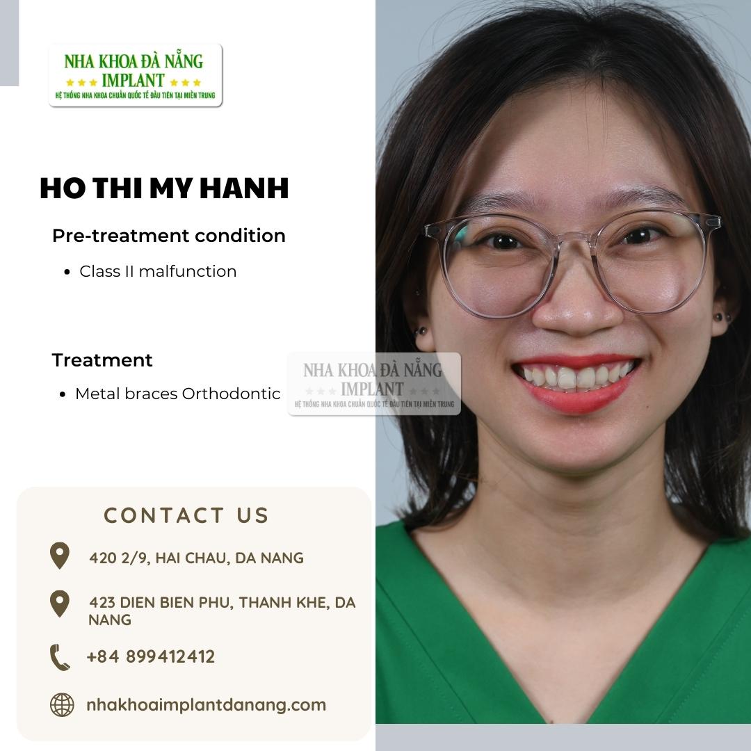 Customer: Ho Thi My Hanh - Treatment: Dental Braces
