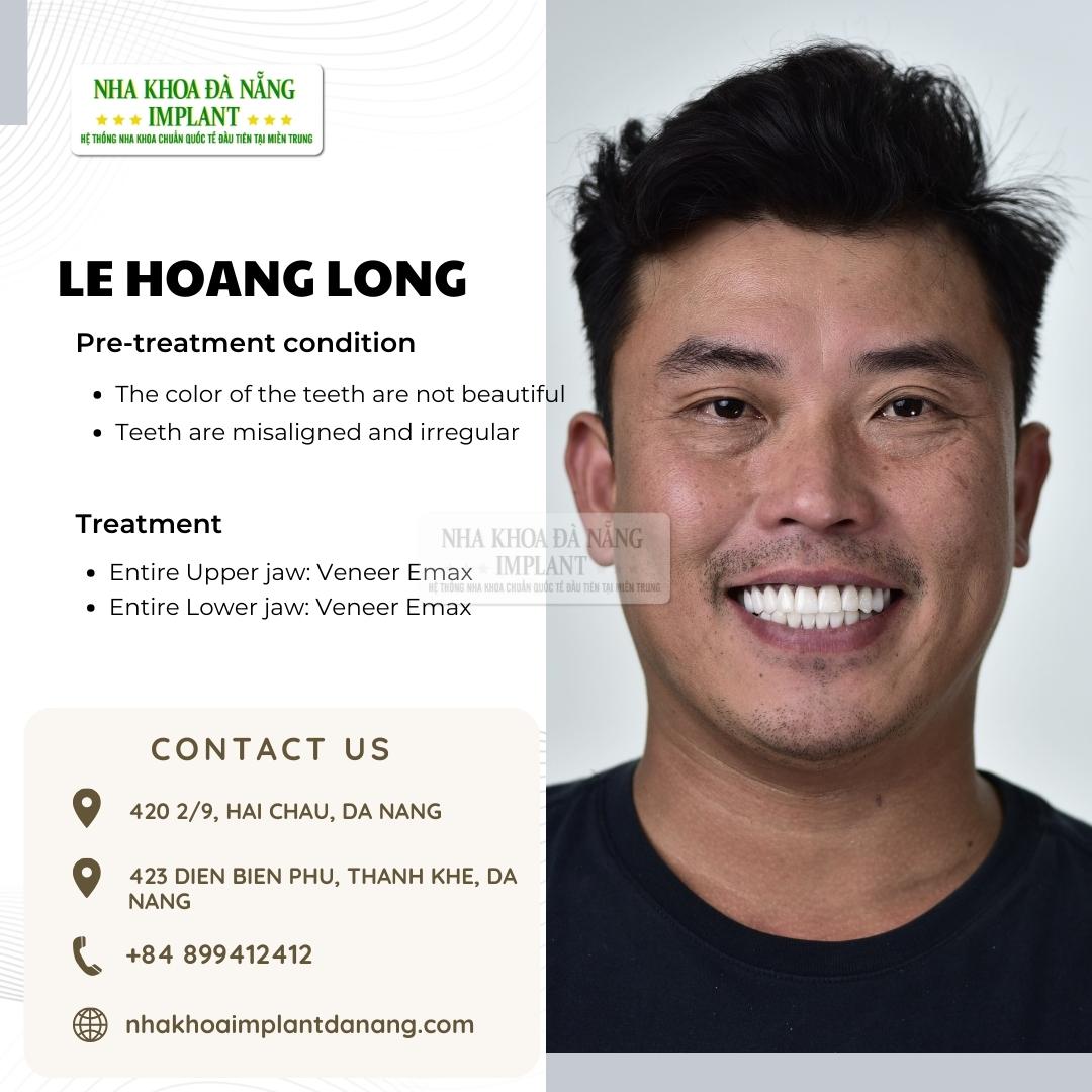 Customer: Le Hoang Long - Treatment: Porcelain Veneers