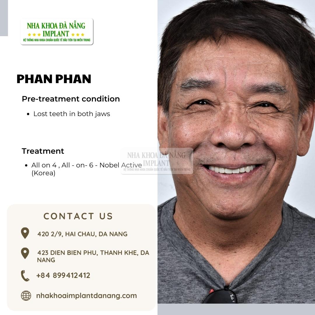 Customer Phan Phan - Treatment: All on 6, All on 4 DIO (Korea)