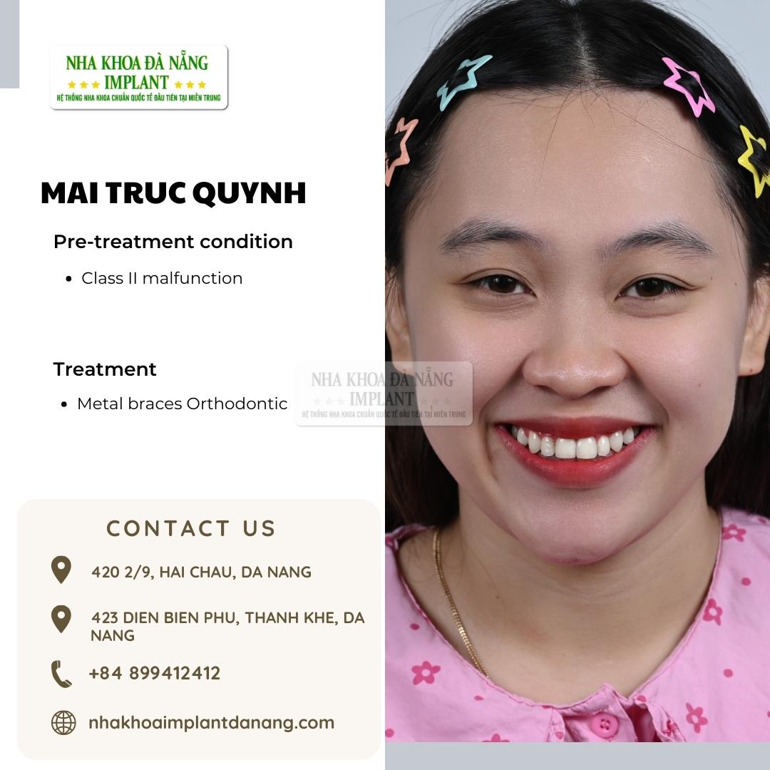 Customer: Mai Truc Quynh - Treatment: Dental Braces