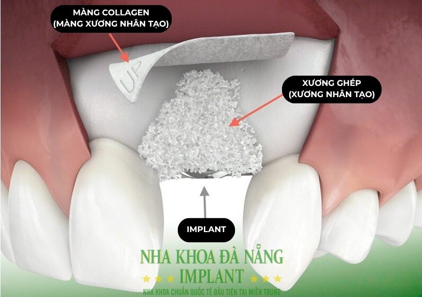 Cấy ghép răng Implant là gì? Cập nhật bảng giá mới nhất
