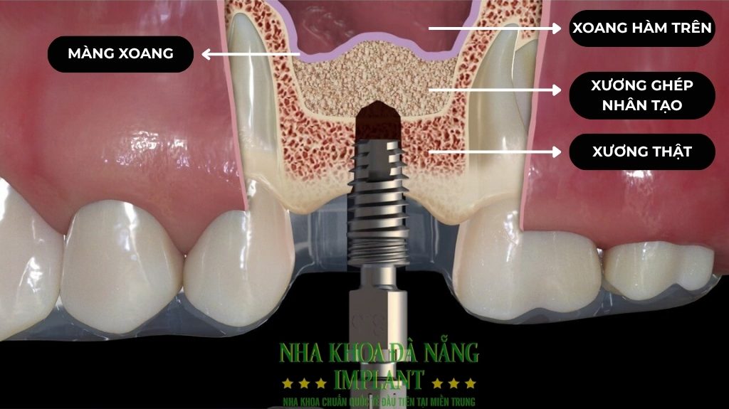 Cấy ghép răng Implant là gì? Cập nhật bảng giá mới nhất