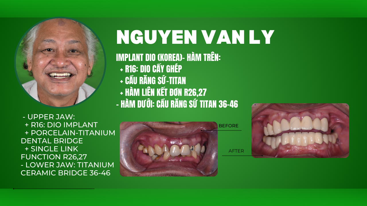 Thoát khỏi nỗi đau mất răng nhờ dịch vụ cấy ghép Implant