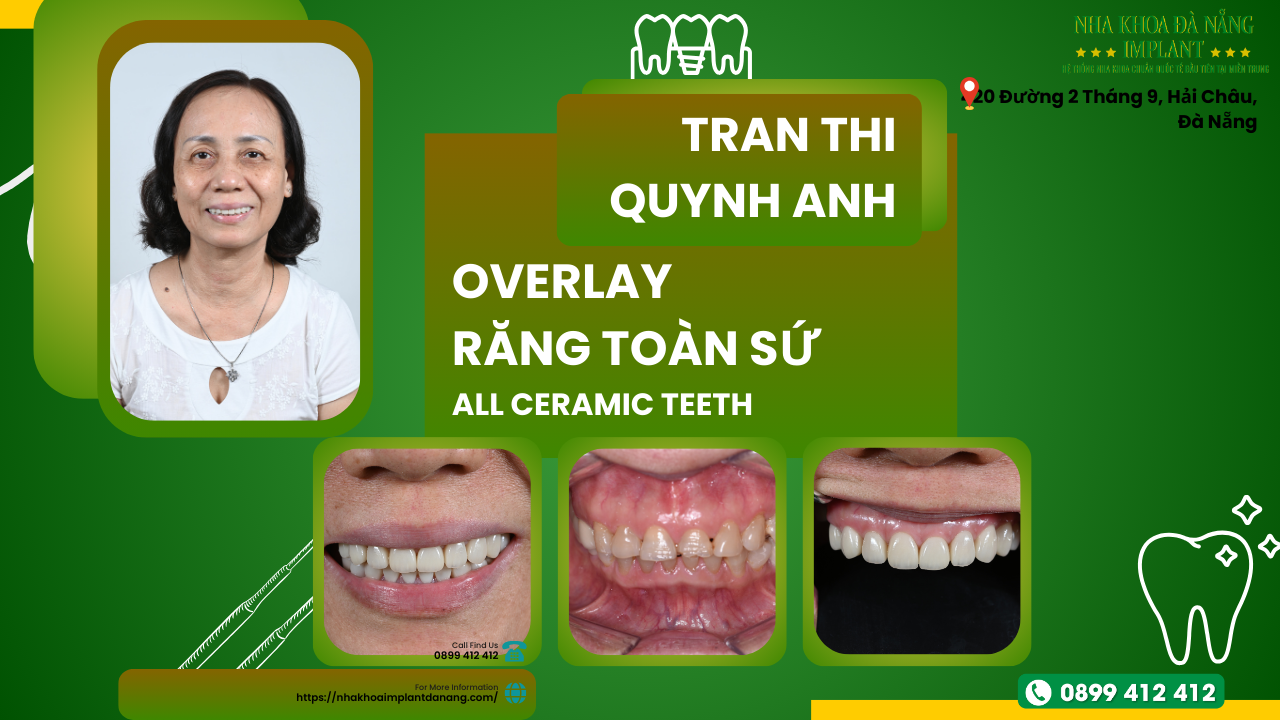 Overlay Dental Filling - The best solution to help you restore chipped teeth