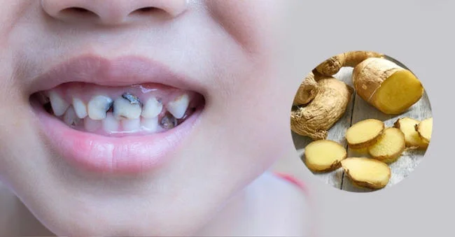 Cách trị sâu răng cho trẻ tại nhà - Cách giảm đau răng