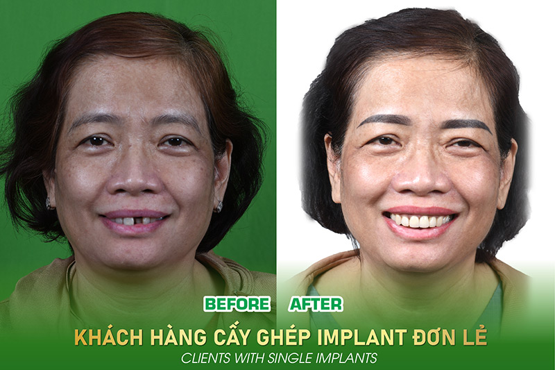 Cấy ghép Implant đơn lẻ