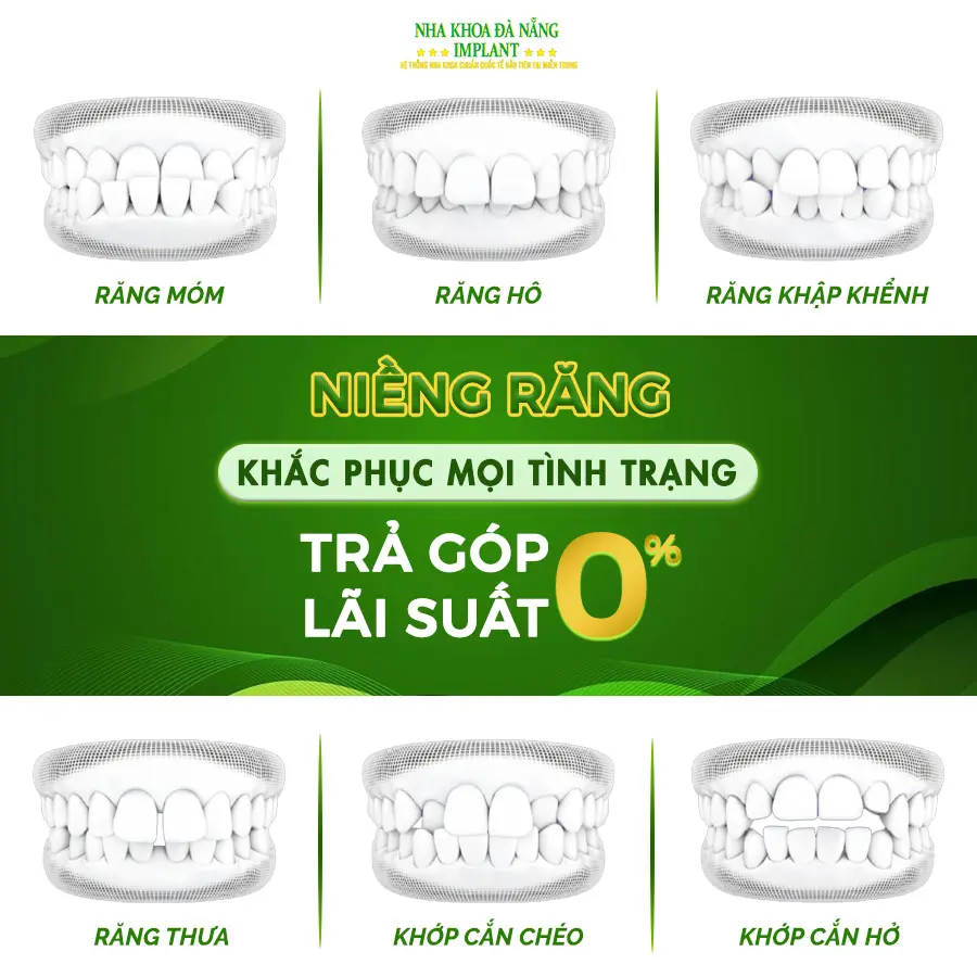 Da Nang Implant Dentistry – Braces are simpler and more “economical” than ever with installment payment service