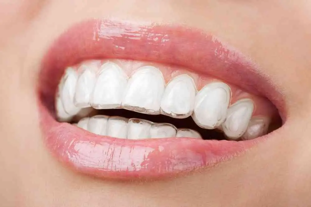 Clear braces are suitable for correcting mildly protruding teeth